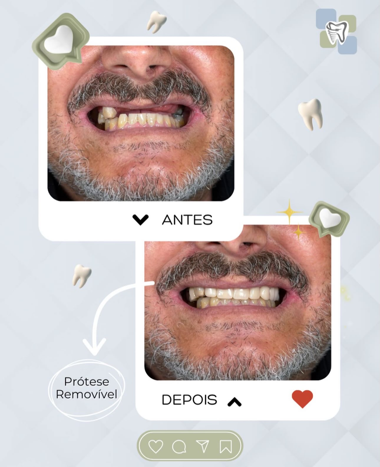 Antes e depois de prótese removível realizado na OdontoMed